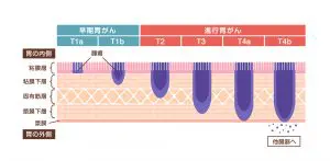 胃の病気（胃潰瘍・十二指腸潰瘍・胃がん・十二指腸がん・急性胃炎