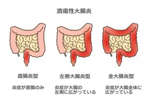 大腸の病気（潰瘍性大腸炎・クローン病） | 米沢市の消化器・内視鏡内科なら、きだ内科クリニック