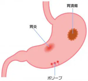 胃の病気（胃潰瘍・十二指腸潰瘍・胃がん・十二指腸がん・急性胃炎